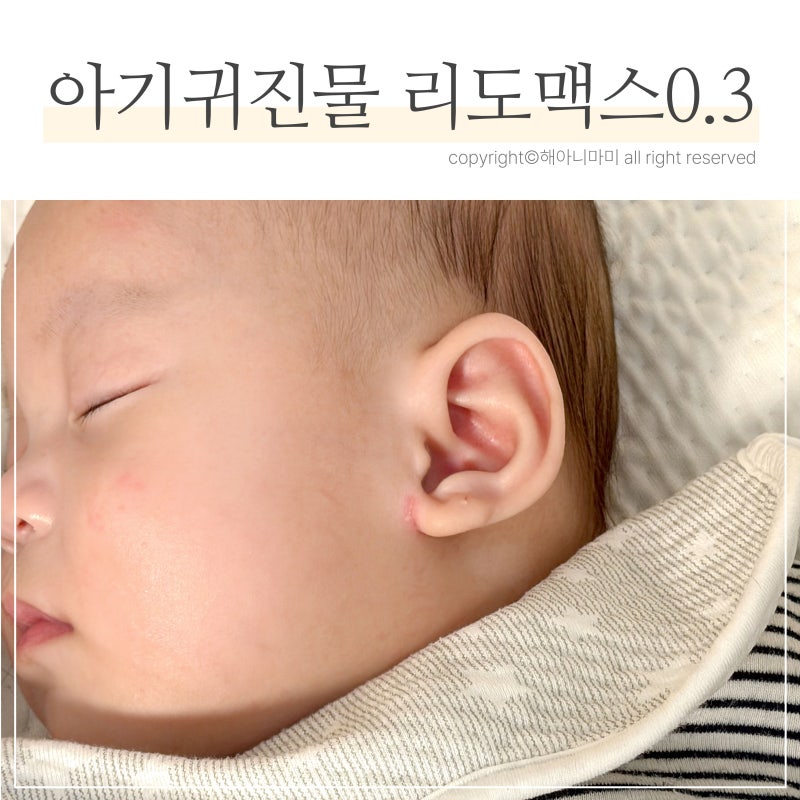 아기 귀진물, 리도맥스 0.3 연고 사용후기