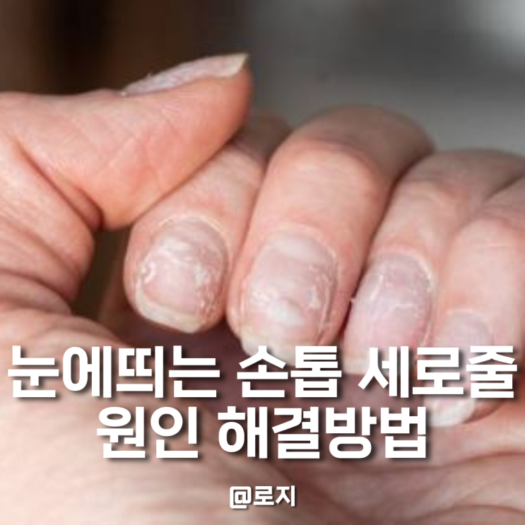  손톱세로줄 울퉁불퉁 원인 해결방법