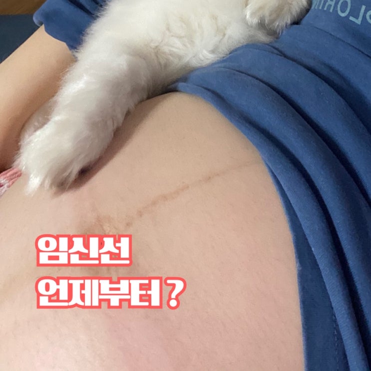  임신선, 언제부터 생길까? 원인과 관리 방법 정리