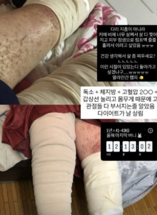   “살 다 찢어지고 림프액이…” 최준희, 96kg 시절 충격적인 건강 상태 고백