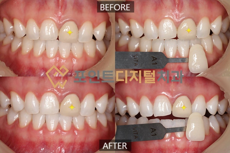  [탕정치과]  오스템 뷰티스 원데이 치아미백 케이스 / 천안 아산