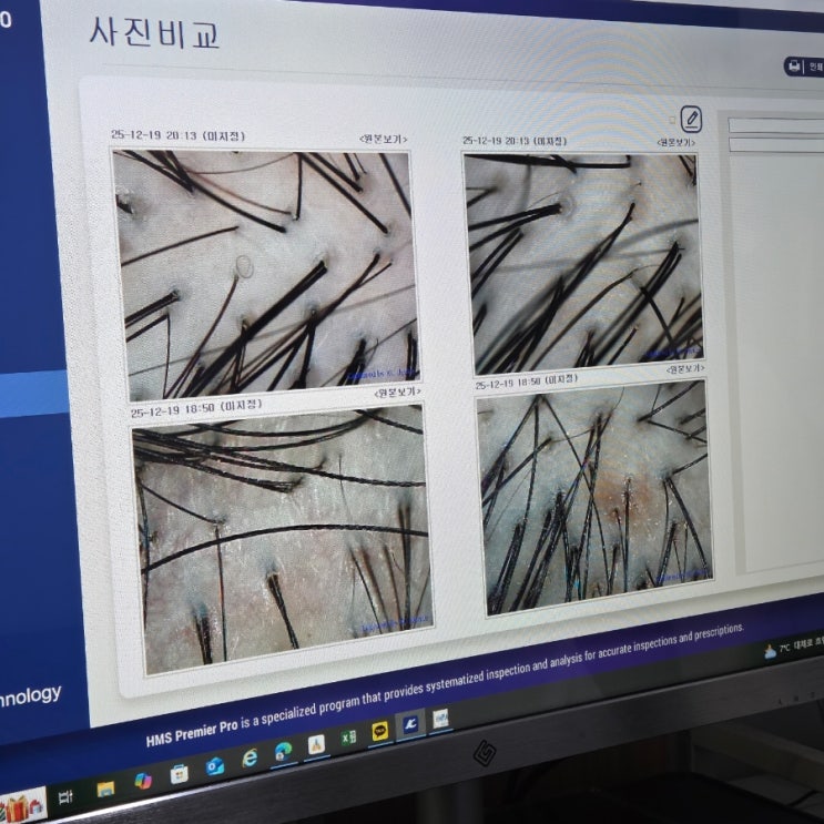  인천탈모 두피관리 닥터모락 가격 지루성두피관리 결국 재방문