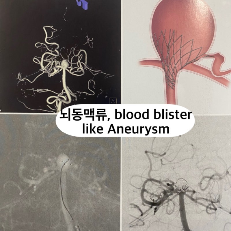 뇌동맥류 Blood Blister like Aneurysm (BBA)란? 원인, 진단, 치료까지