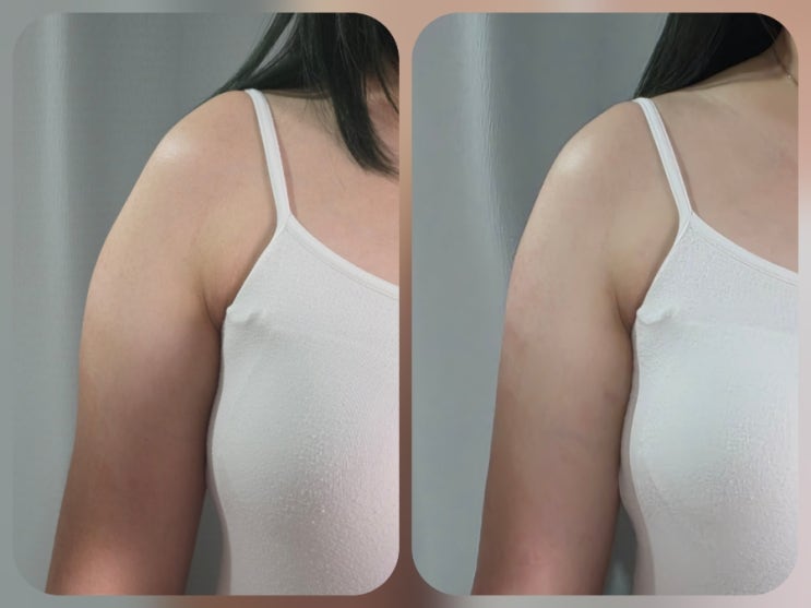  [장유율하]통증없이 슬림한 팔뚝으로 변신가능한 팔뚝살슬림젯 율하에스테틱 '홍쓰네뷰티 김해율하본점'