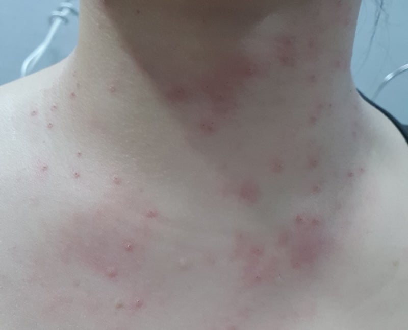 서울 편평사마귀, 쥐젖 제거 성지 정보, CO2 레이저로 제거 후기 (라르떼의원)