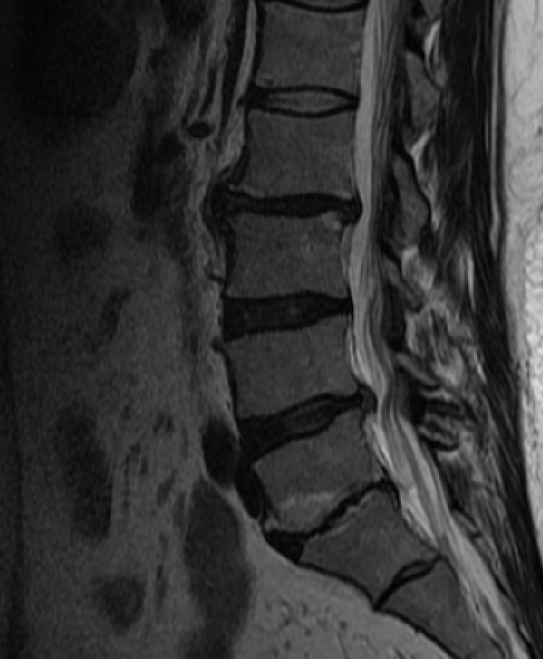 목·허리 디스크 MRI 비용 급여 기준｜신경학적 이상 증상 있으면 가능