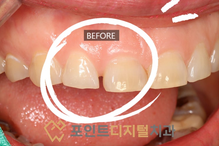  [탕정치과]  바이오클리어를 이용한 앞니 벌어짐 레진 치료 / 천안 아산