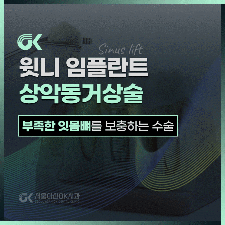  상악동거상술 통한 남양주 윗니 임플란트