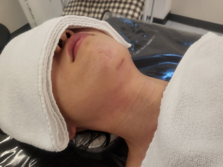  이중턱지방흡입 바본, 왜 생기고 언제 풀릴까요? 단단함 회복 과정 정리
