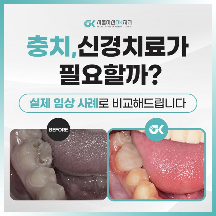  [임상사례] 하남신경치료없이 어린이 충치치료 과정