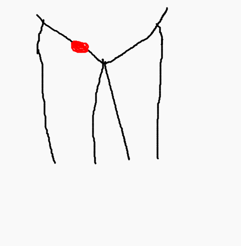 사타구니, 팬티라인, Y존에 피지낭종/표피낭종/육아종 생긴자 모여라....제거 수술 후기 1탄