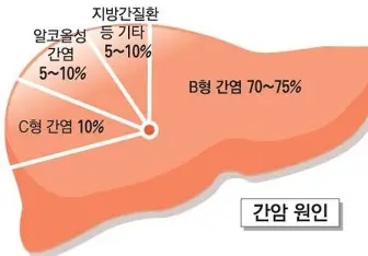 B형 급성 간염