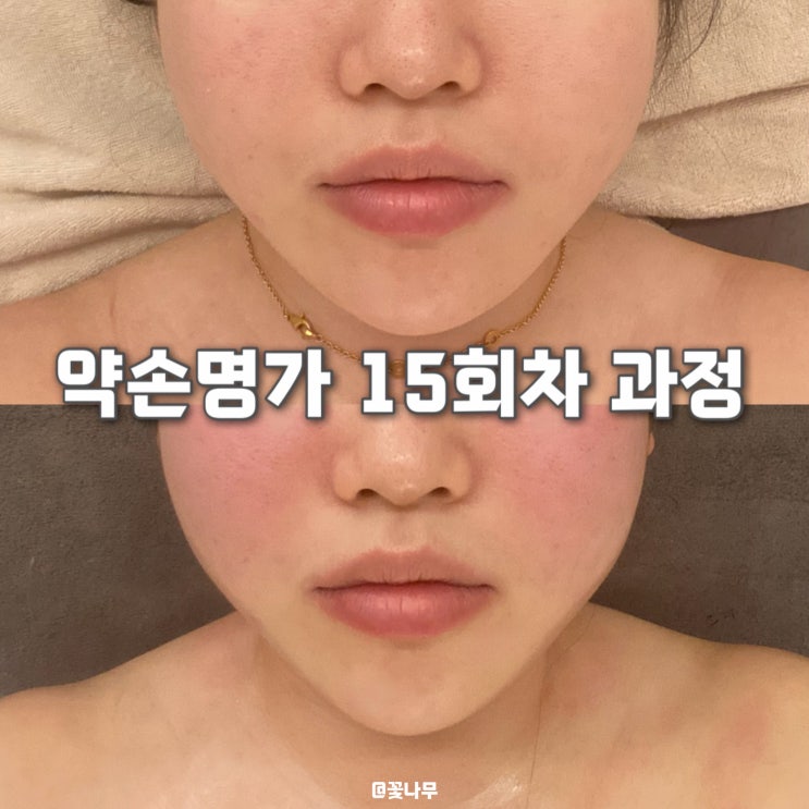  사진빨 안 받던 얼굴, 구리약손명가 윤곽관리 15회로 얼마나 달라질까