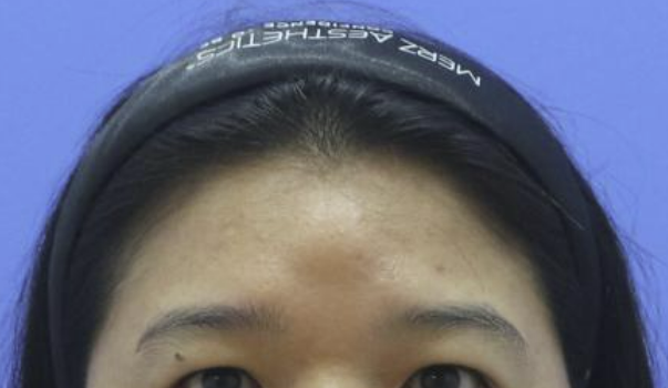 광주 이마혹, 내시경 이마지방종제거. 전주, 여수, 목포, 순천, 익산, 군산
