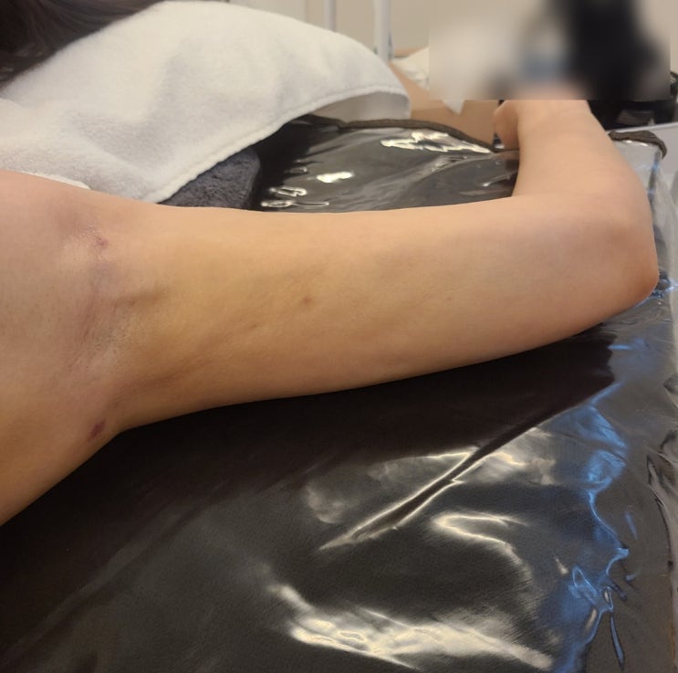  팔 지방흡입 바이오본드  왜 단단해지고 붓는 걸까요? 회복 과정 정리