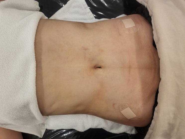  복부 지방흡입 바본 관리 언제부터 필요할까? 단단함 풀리는 골든타임