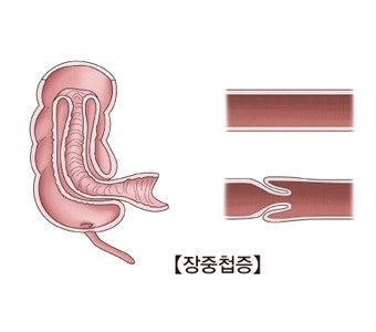 육아 정보) 아기가 배가 너무 아프대요! 장 꼬임 장중첩증 증상 수술 원인 검사 정복술 장절....