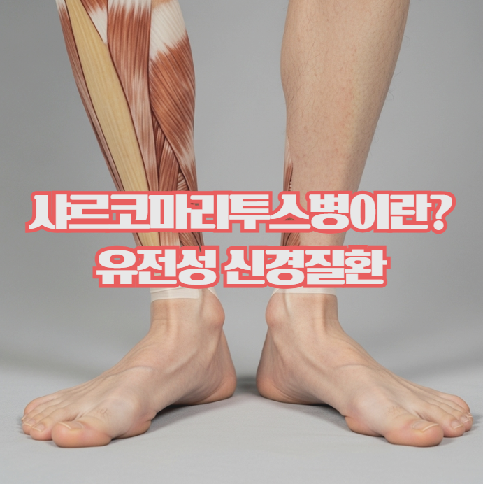  샤르코마리투스병이란 ? 증상과 특징 정리