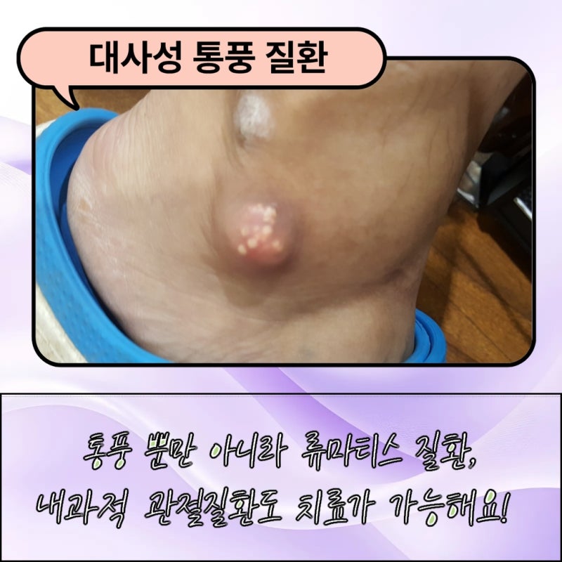 대전 통풍치료 병의원 어떤 진료과를 선택해야 할까요?
