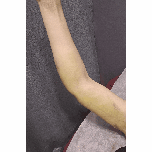 결혼 앞둔 예비신부 팔뚝 무한람스 리얼 후기 ⑥ 람스 1주일 후 후관리 내원기 | 부종·멍·체중 변화 기록