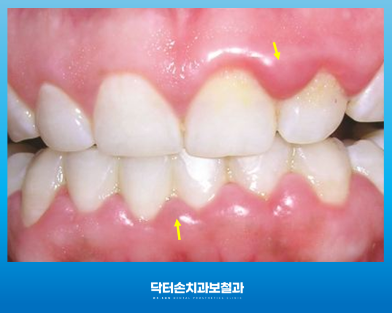 수성구 어린이 잇몸 염증 증상과 치료방법