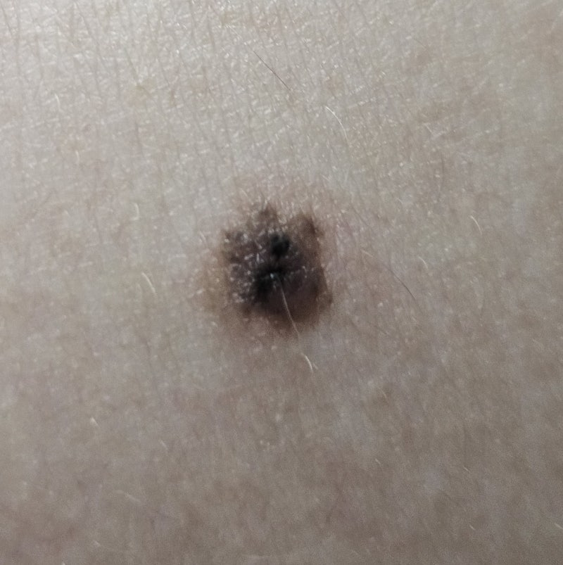 흑색종의심으로 강북삼성병원 조직검사 받은 후기
