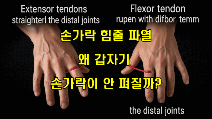  손가락 힘줄 파열, 왜 갑자기 손가락이 안 펴질까?