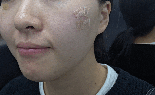  점 빼고 생긴 패인흉터 제거 | 수원한의원 새살침 치료 후기