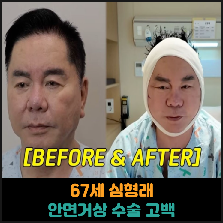  67세 심형래, 안면거상 수술 고백