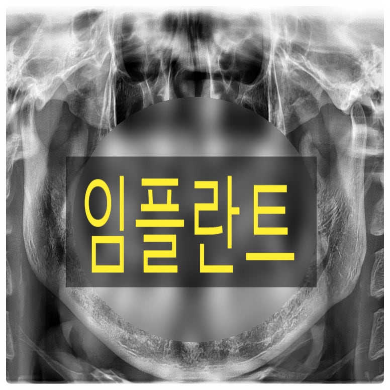임플란트 여러분은 어디서 하나요? 강남 석플란트에 가다! 2025년 12월 23일 일기