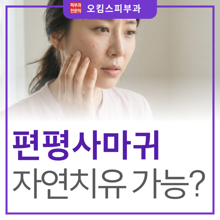  일산동 피부과 편평사마귀 자연치유, 정말 가능할까?