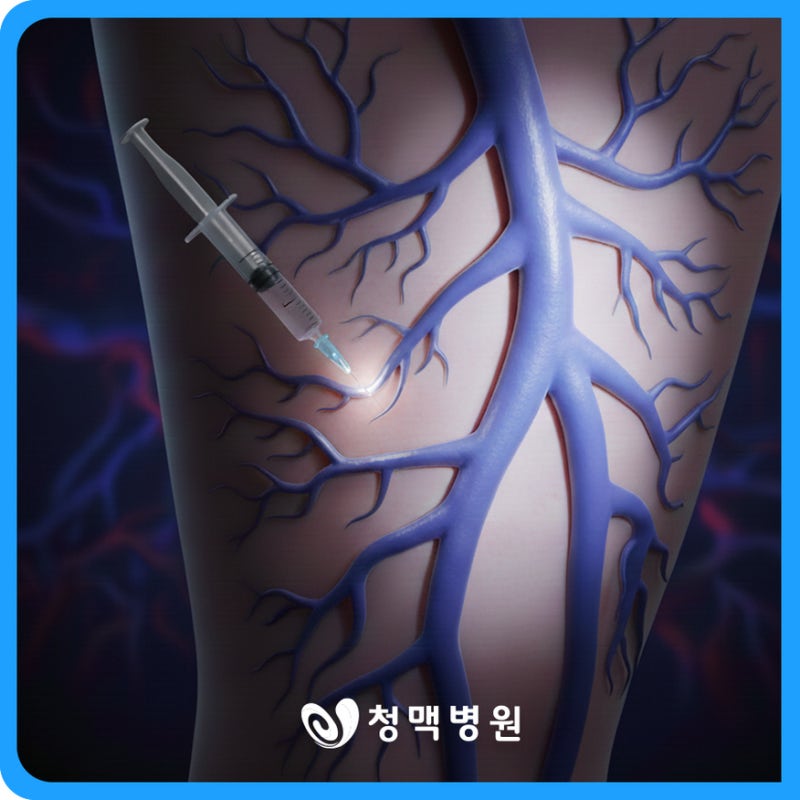 하지정맥류주사치료 하나만 고집하면 안 되는 치명적 이유