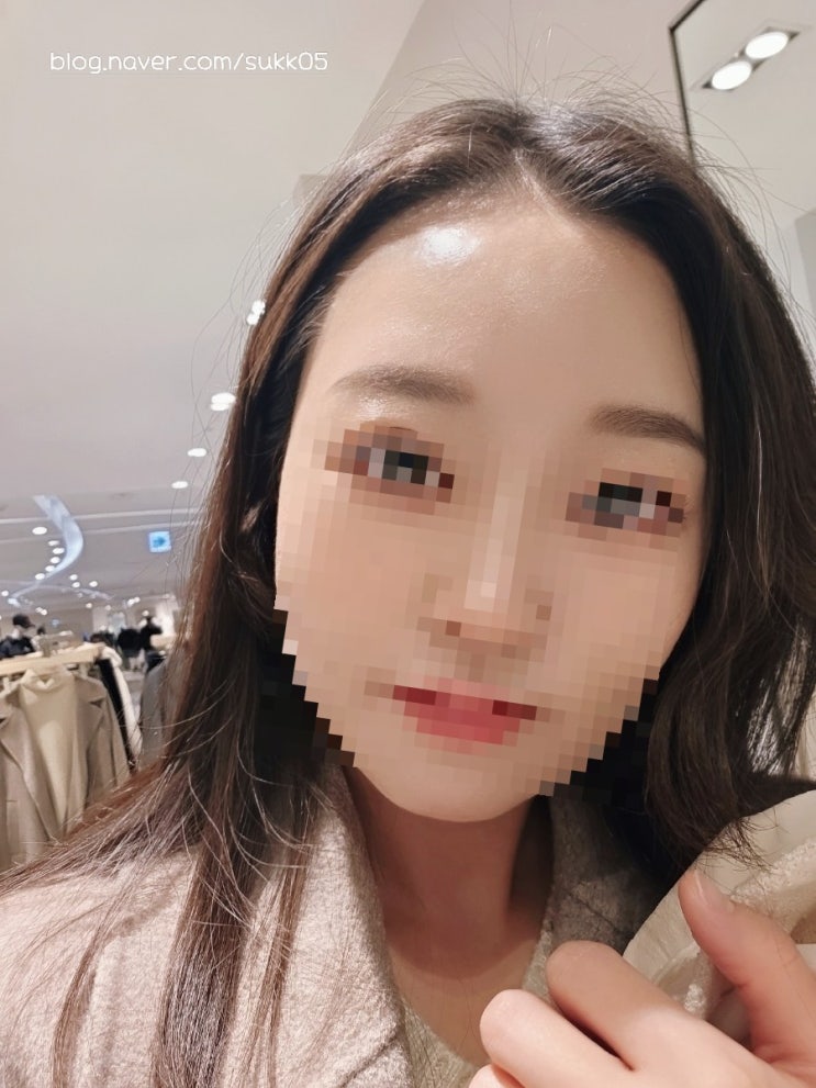  창원 이마필러 7cc후기(2탄)3일차부터 이마몰딩까지 현재까지의 변화