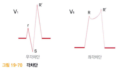 심전도(ECG/EKG) 리듬과 특징