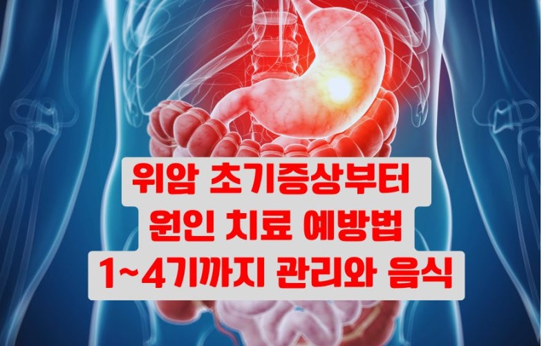 위암 초기 증상 원인 치료 1기~4기 관리 음식, 예방법은?