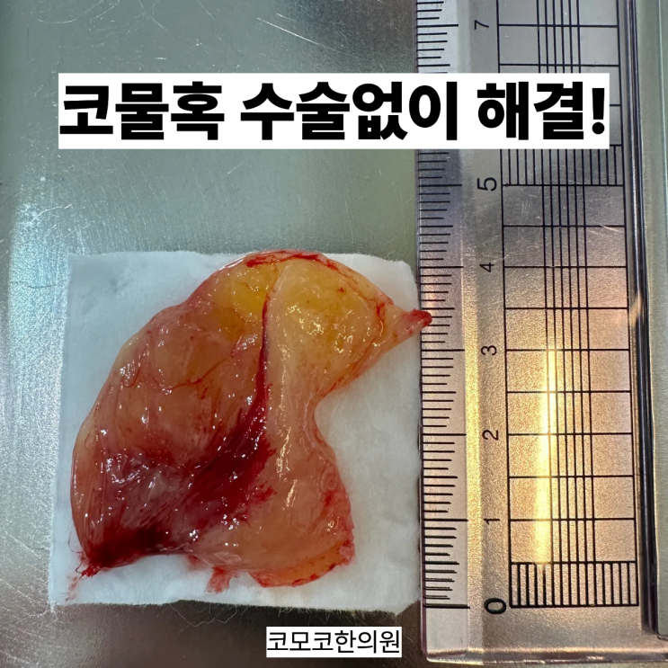  코물혹 수술 없이 해결할 수 있습니다