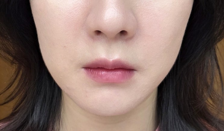 신촌피부과 힐로웨이브 팔자 가격 후기 효과