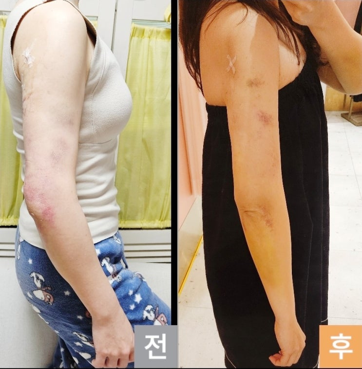  결혼 앞둔 예비신부 팔뚝 무한람스 리얼후기 ⑦｜2주 만에 –1.2cm, 옷 핏이 달라졌다