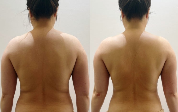  [양산]원장님의 손맛과 전문적인 스킬로 라운드숄더에 효과적인 양산바디관리 '온스에스테틱 양산점'