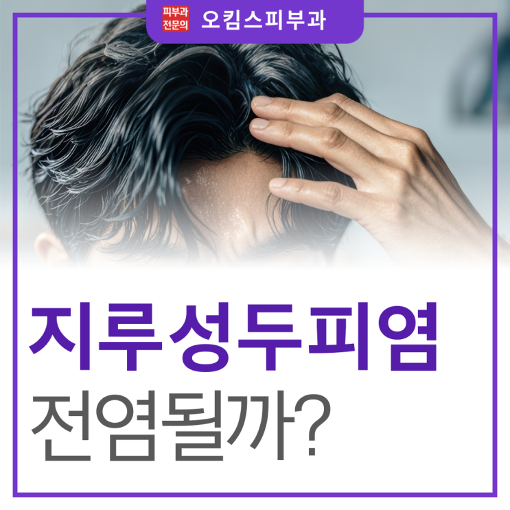  일산 마두역 탈모관리 지루성두피염 전염 되나요? 탈모 유발 진실은