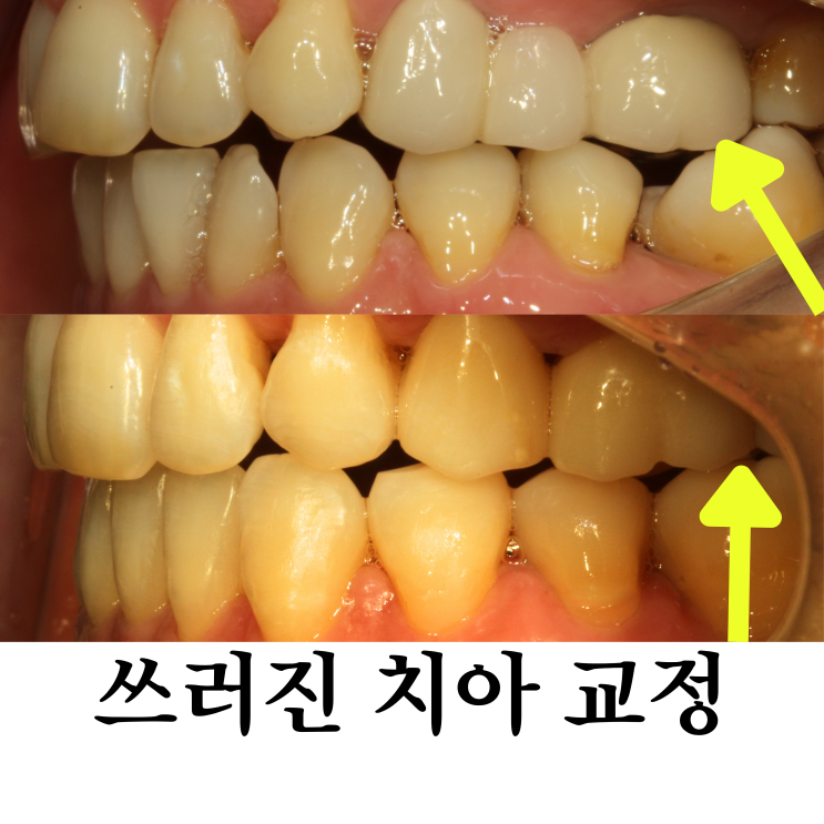  노원교정과전문의, 보철 전 교정으로 임플란트 치료 계획 조정한 사례