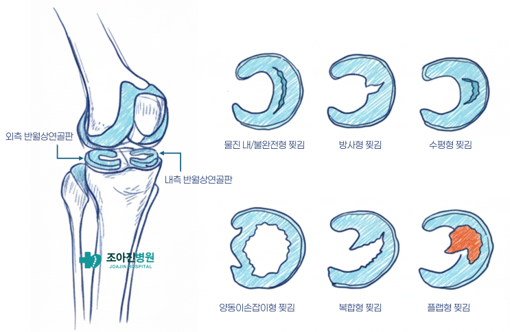  광주 무릎 통증 심층분석-반월상 연골판 파열 :  수술 vs 보존적 치료