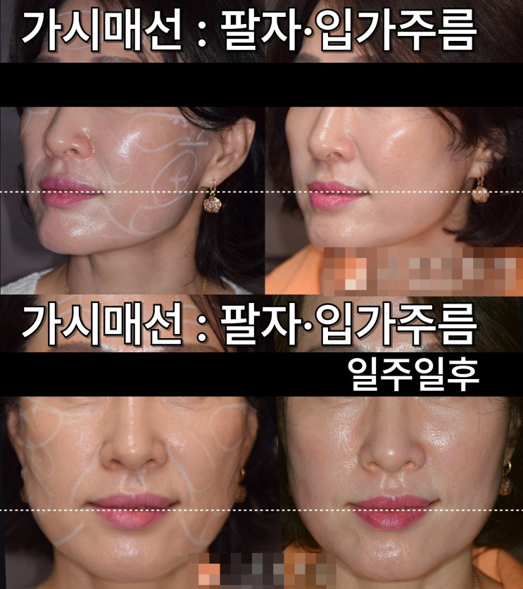  포항 성형외과, 모든 처짐이 수술 대상은 아닙니다