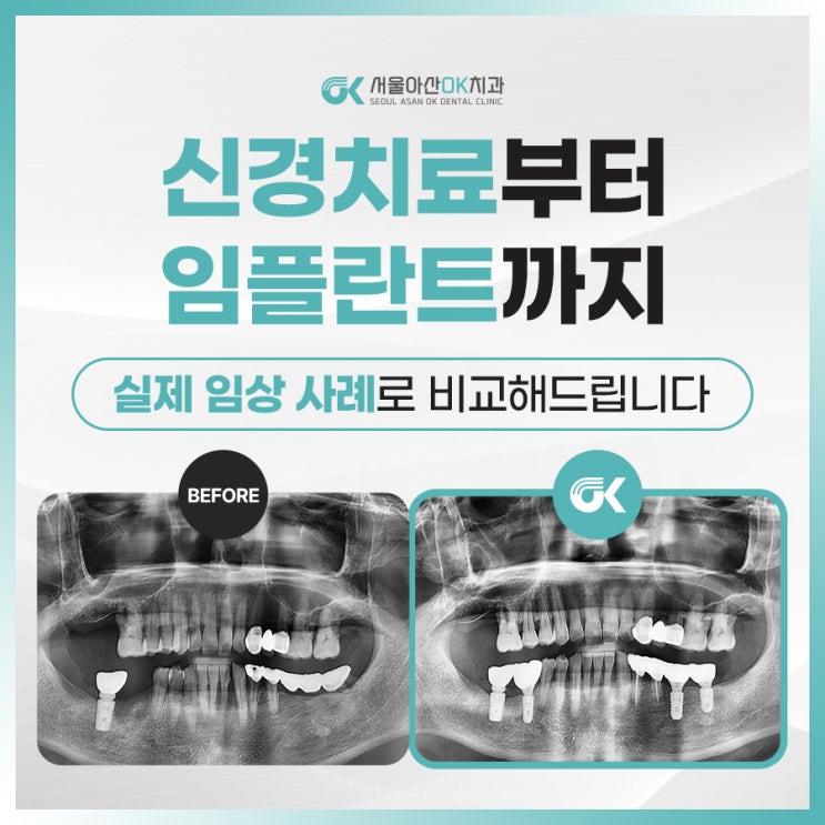  [임상사례]미사 신경치료부터 임플란트까지