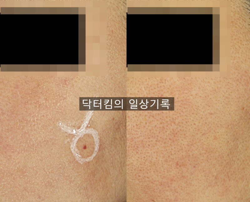 얼굴 피부 빨간점 혈관종 제거, 혈관 레이저 치료 및 관리 방법 [by 피부과 전문의 닥터킴]