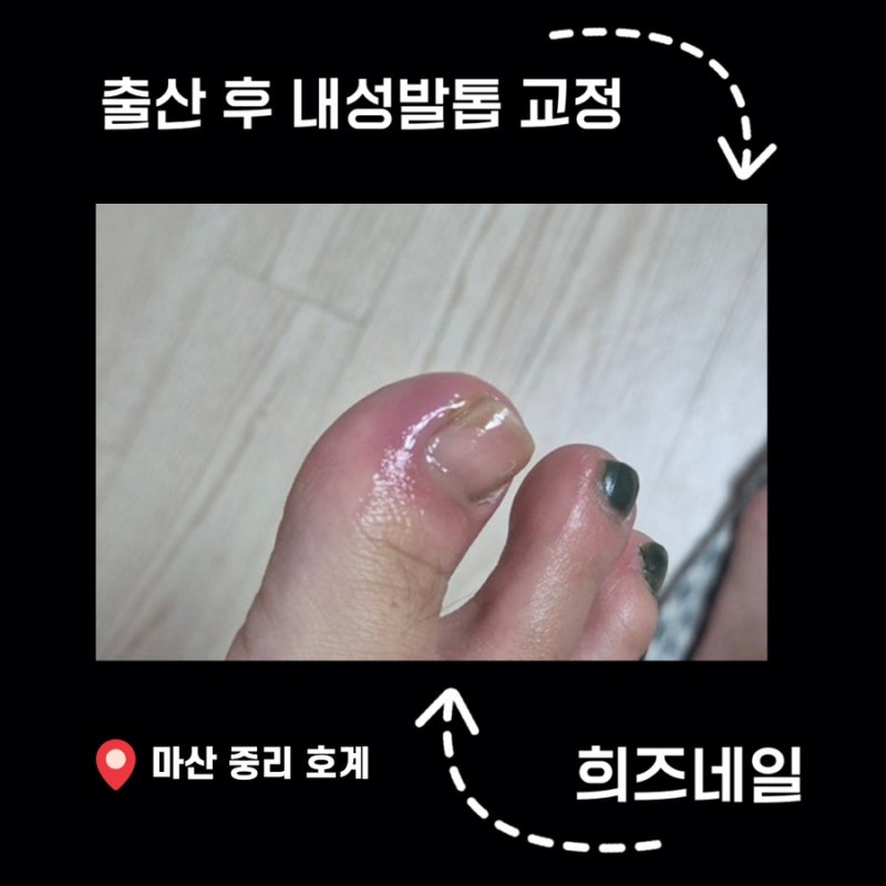 출산 후 생긴 발톱문제 해결! 마산 희즈네일 내성발톱 교정 리얼 후기