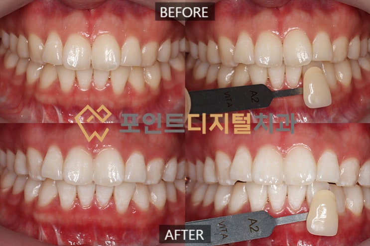  [탕정치과]  오스템 뷰티스 원데이 치아미백 케이스 / 천안 아산