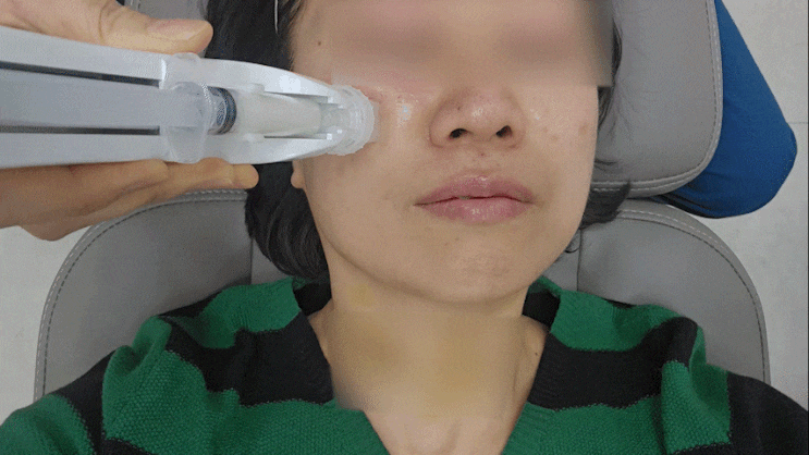  [강남역피부과] 베개 자국이 안 사라진다면? 스킨부스터 셀르디엠 비포애프터 효과 후기