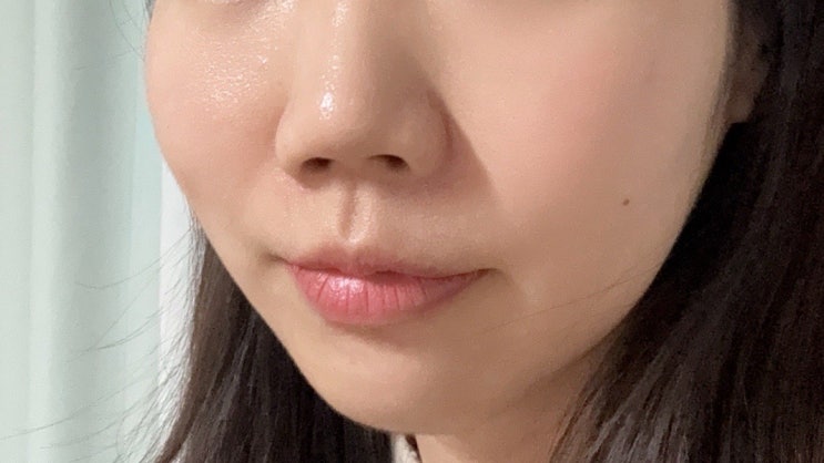  강남피부과 포텐자 4회차:) 비포애프터 디테일한 찐후기