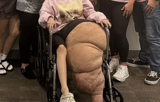   한쪽 다리만 79kg까지 자라난 소녀의 눈물겨운 사투와 새로운 희망